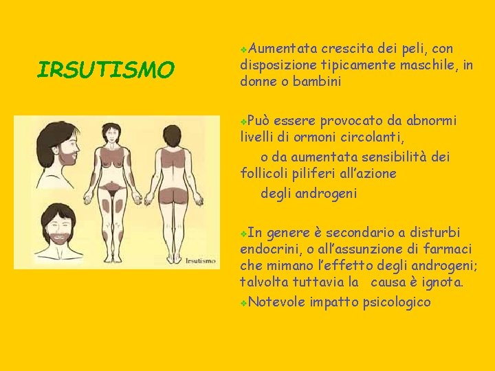 IRSUTISMO Aumentata crescita dei peli, con disposizione tipicamente maschile, in donne o bambini v
