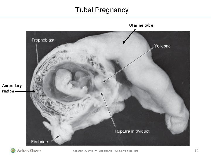 Tubal Pregnancy Uterine tube Ampullary region Copyright © 2019 Wolters Kluwer • All Rights Tubal Pregnancy Uterine tube Ampullary region Copyright © 2019 Wolters Kluwer • All Rights