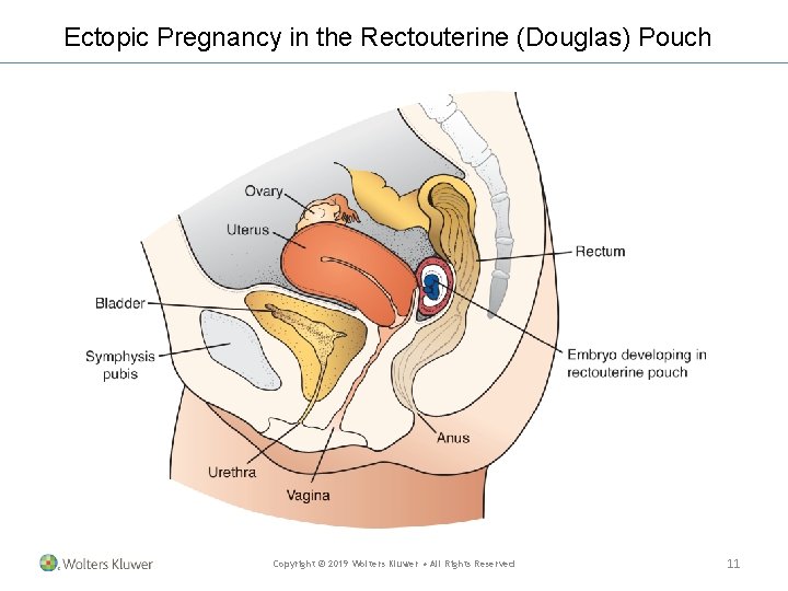 Ectopic Pregnancy in the Rectouterine (Douglas) Pouch Copyright © 2019 Wolters Kluwer • All Ectopic Pregnancy in the Rectouterine (Douglas) Pouch Copyright © 2019 Wolters Kluwer • All