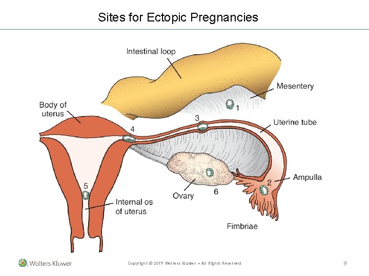 Sites for Ectopic Pregnancies Copyright © 2019 Wolters Kluwer • All Rights Reserved 9 Sites for Ectopic Pregnancies Copyright © 2019 Wolters Kluwer • All Rights Reserved 9