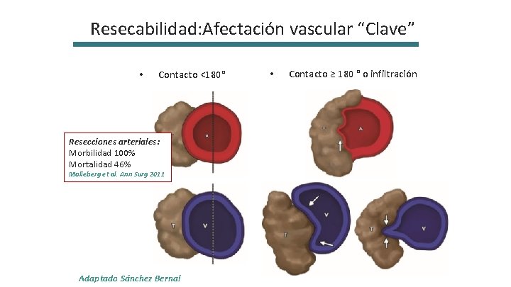 Resecabilidad: Afectación vascular “Clave” • Contacto <180° Resecciones arteriales: Morbilidad 100% Mortalidad 46% Molleberg