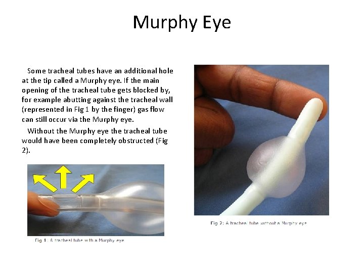 Murphy Eye Some tracheal tubes have an additional hole at the tip called a
