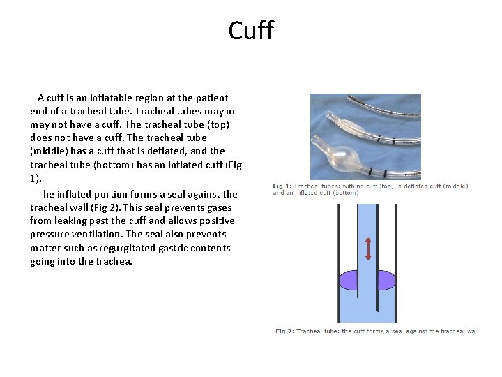Cuff A cuff is an inflatable region at the patient end of a tracheal