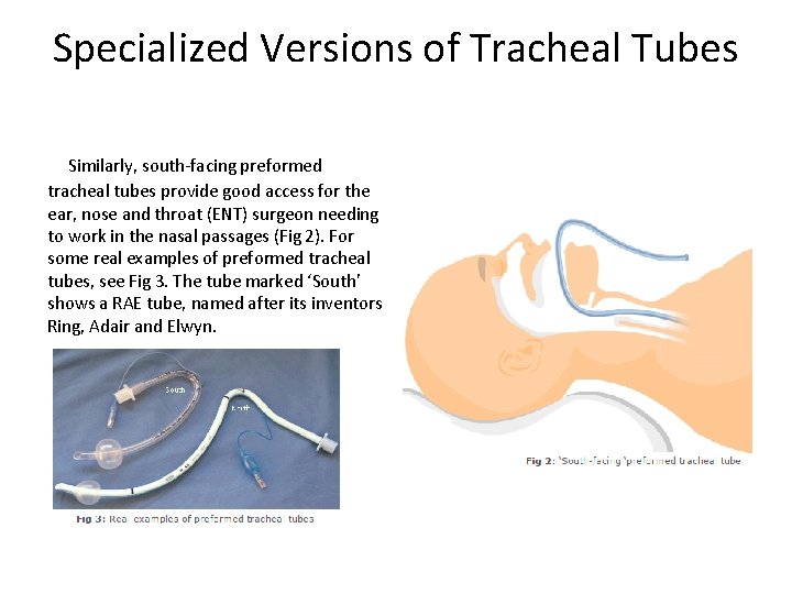 Specialized Versions of Tracheal Tubes Similarly, south-facing preformed tracheal tubes provide good access for