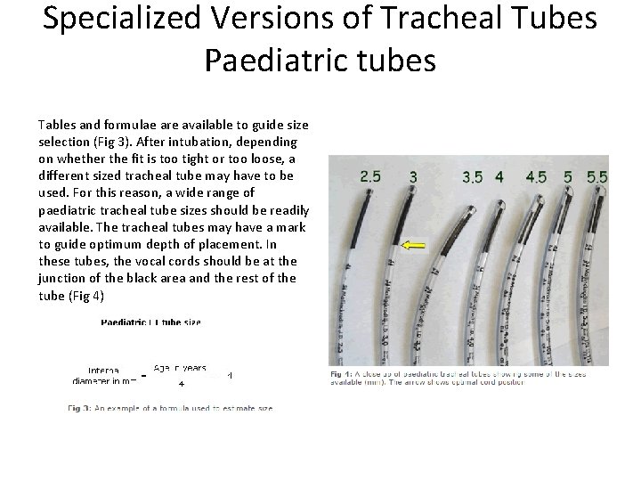 Specialized Versions of Tracheal Tubes Paediatric tubes Tables and formulae are available to guide
