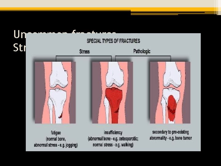 Uncommon fractures Stress and pathologic etiologies 