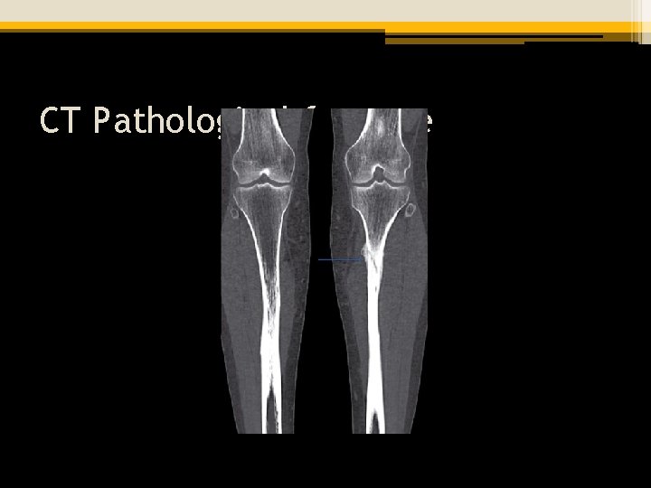 CT Pathological fracture 
