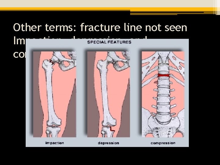 Other terms: fracture line not seen Impaction, depression, and compression 