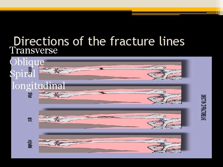 Directions of the fracture lines Transverse Oblique Spiral longitudinal 