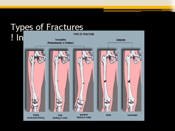 Types of Fractures ! Incomplete vs Complete 