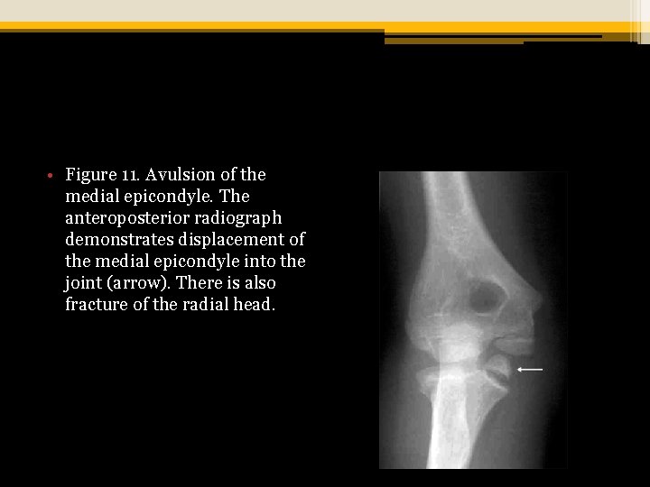  • Figure 11. Avulsion of the medial epicondyle. The anteroposterior radiograph demonstrates displacement