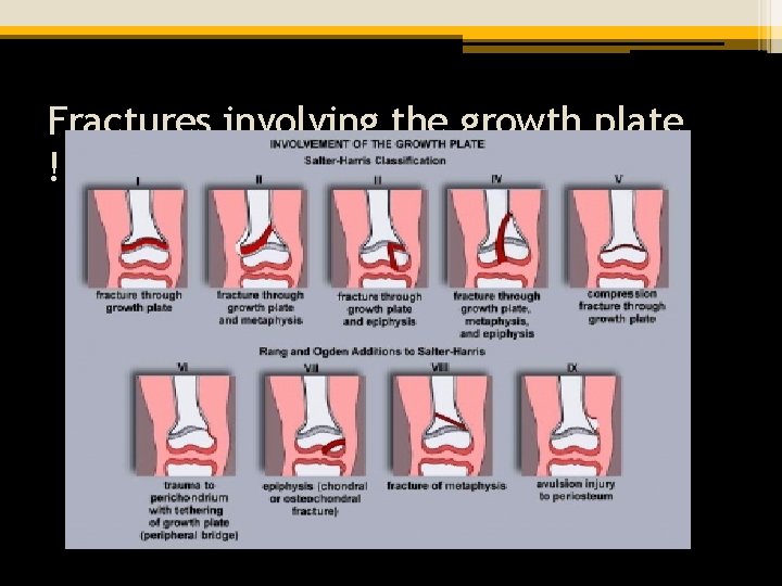 Fractures involving the growth plate ! Salter-Harris Classification 