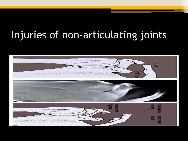 Injuries of non-articulating joints 