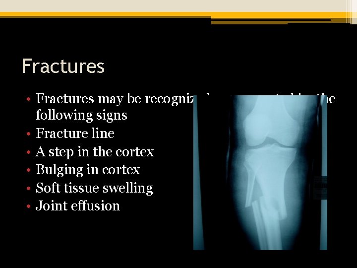 Fractures • Fractures may be recognized or suspected by the following signs • Fracture
