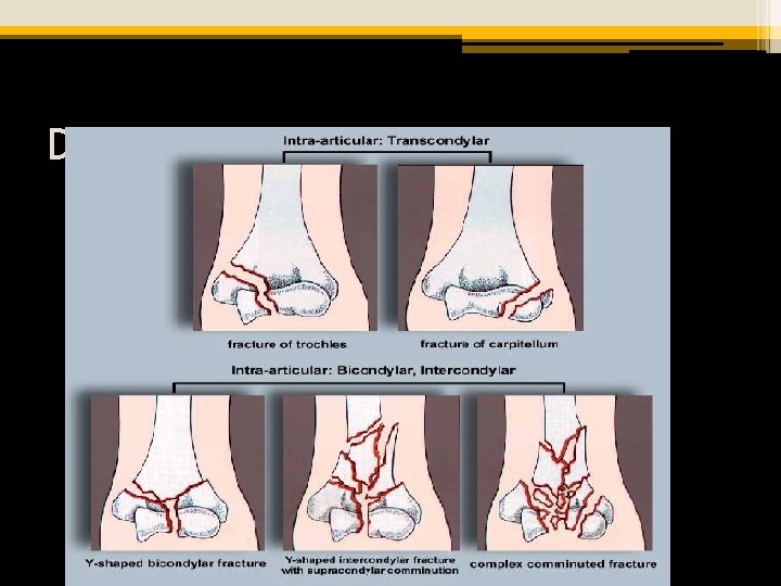 Distal Humeral Fractures 