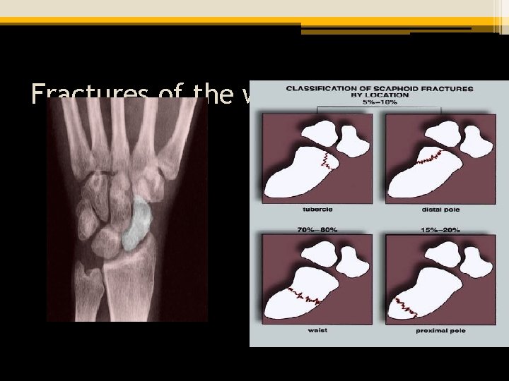 Fractures of the wrist-scaphoid 