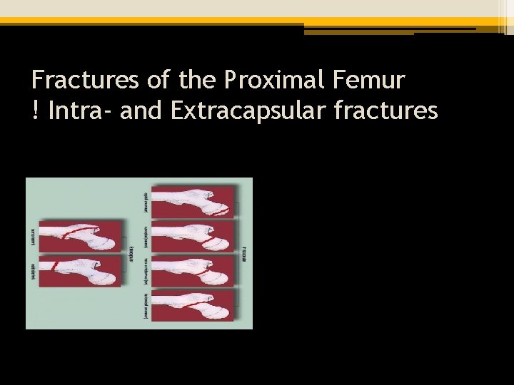 Fractures of the Proximal Femur ! Intra- and Extracapsular fractures 