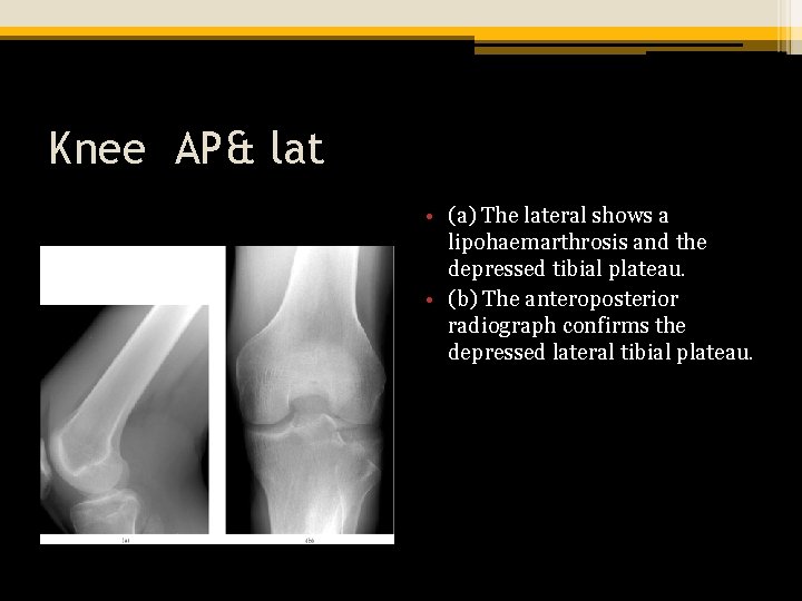 Knee AP& lat • (a) The lateral shows a lipohaemarthrosis and the depressed tibial