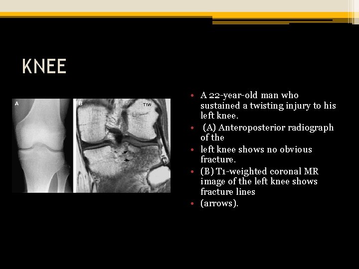 KNEE • A 22 -year-old man who sustained a twisting injury to his left