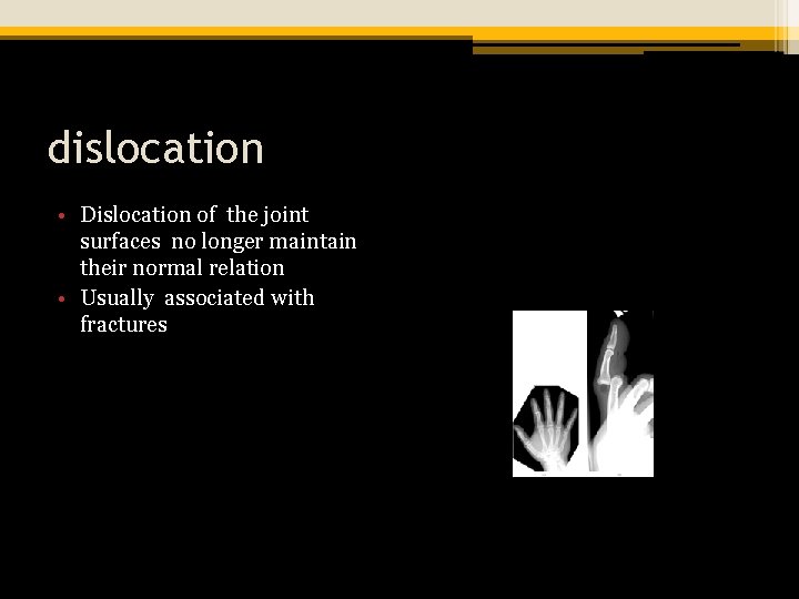 dislocation • Dislocation of the joint surfaces no longer maintain their normal relation •