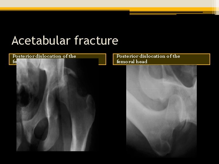 Acetabular fracture Posterior dislocation of the femoral head 