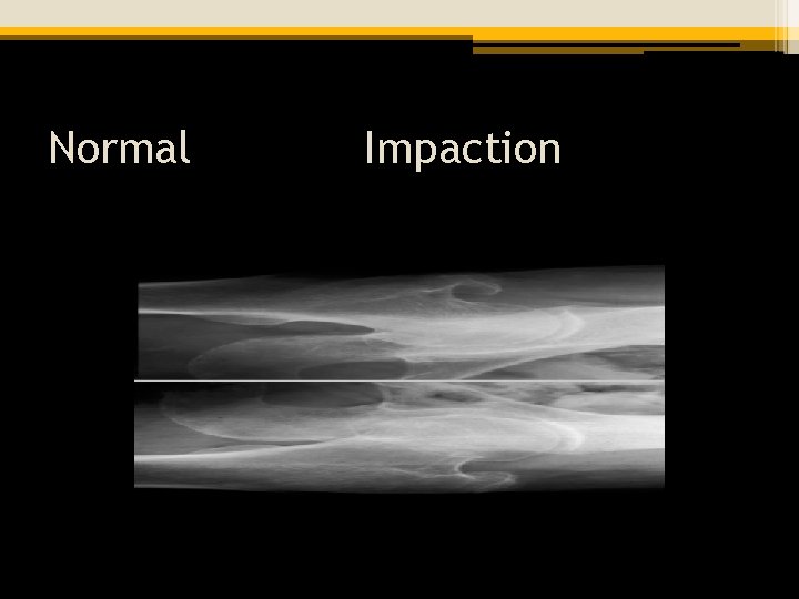 Normal Impaction 