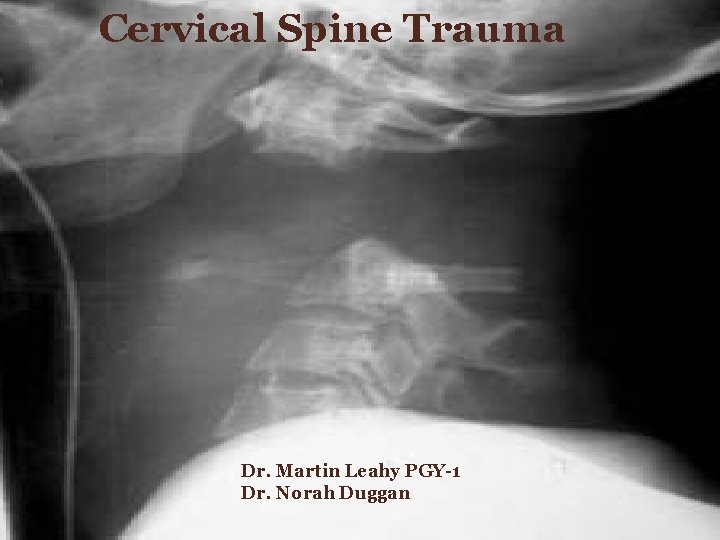 Cervical Spine Trauma Dr. Martin Leahy PGY-1 Dr. Norah Duggan - Faculty Dr. Martin