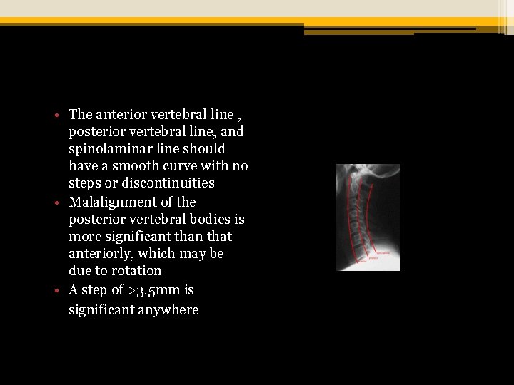  • The anterior vertebral line , posterior vertebral line, and spinolaminar line should