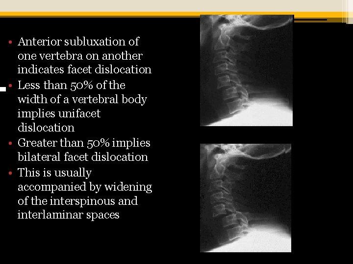  • Anterior subluxation of one vertebra on another indicates facet dislocation • Less