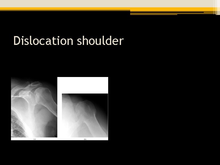 Dislocation shoulder 