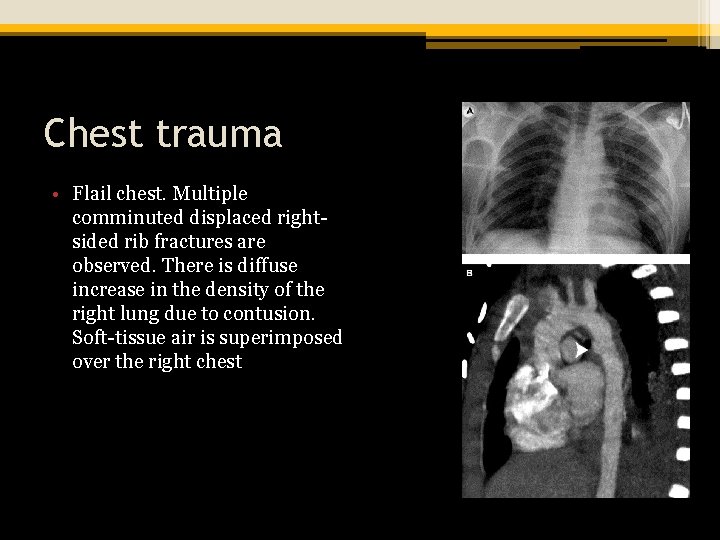 Chest trauma • Flail chest. Multiple comminuted displaced rightsided rib fractures are observed. There
