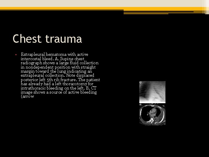 Chest trauma • Extrapleural hematoma with active intercostal bleed. A. Supine chest radiograph shows
