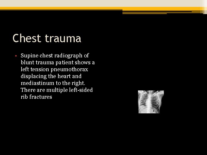 Chest trauma • Supine chest radiograph of blunt trauma patient shows a left tension