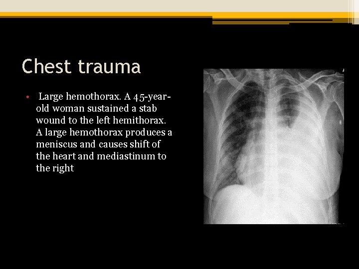 Chest trauma • Large hemothorax. A 45 -yearold woman sustained a stab wound to