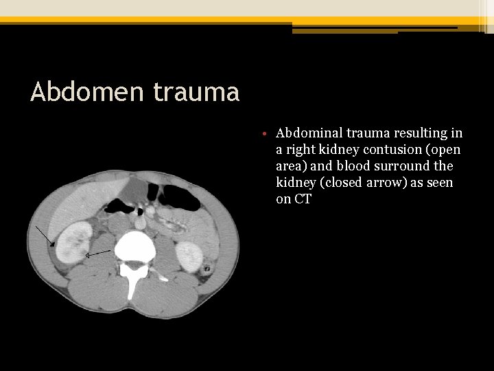 Abdomen trauma • Abdominal trauma resulting in a right kidney contusion (open area) and