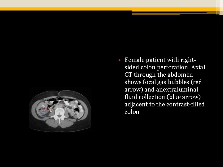  • Female patient with rightsided colon perforation. Axial CT through the abdomen shows