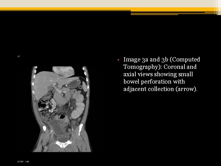  • Image 3 a and 3 b (Computed Tomography): Coronal and axial views
