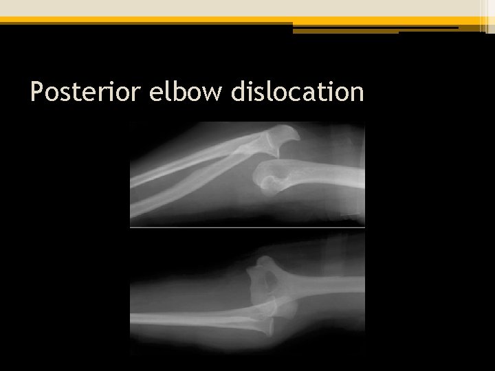 Posterior elbow dislocation 