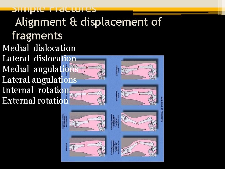 Simple Fractures Alignment & displacement of fragments Medial dislocation Lateral dislocation Medial angulations Lateral