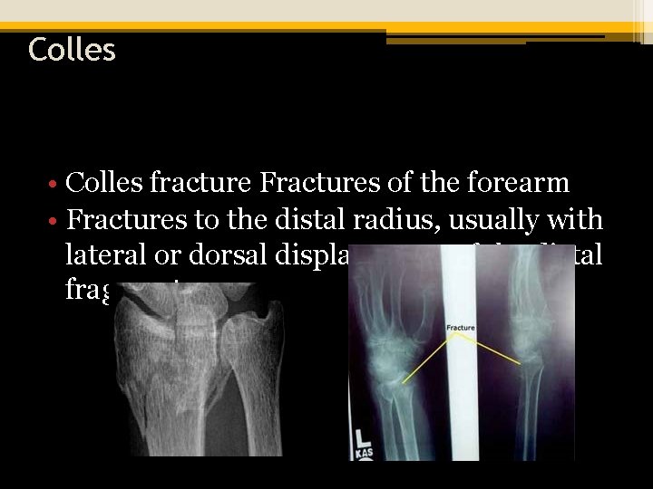 Colles • Colles fracture Fractures of the forearm • Fractures to the distal radius,