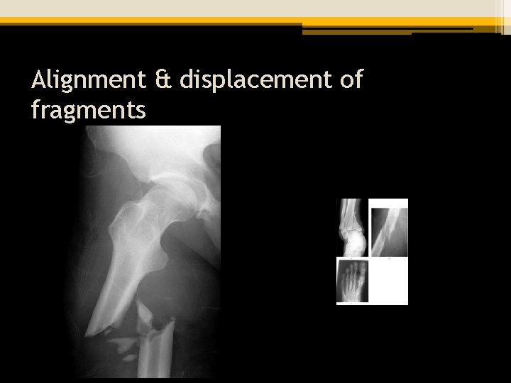 Alignment & displacement of fragments 