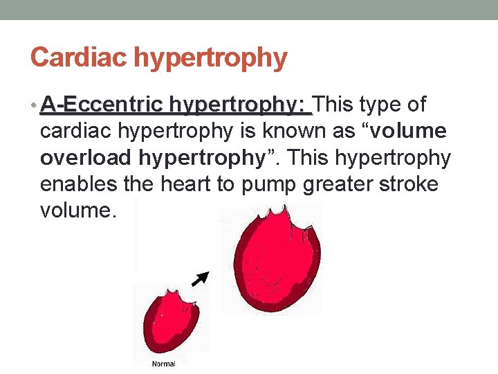 Cardiac hypertrophy • A-Eccentric hypertrophy: This type of cardiac hypertrophy is known as “volume