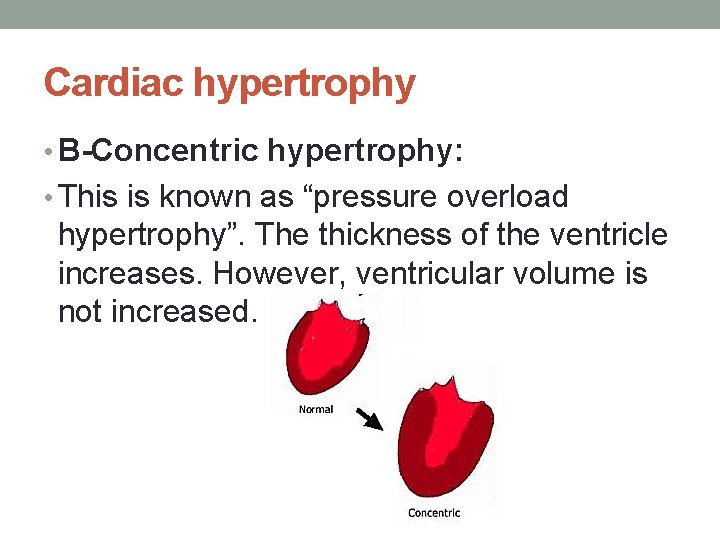 Cardiac hypertrophy • B-Concentric hypertrophy: • This is known as “pressure overload hypertrophy”. The