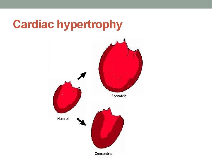 Cardiac hypertrophy 