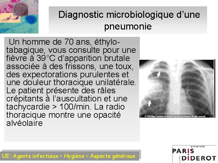 Diagnostic microbiologique d’une pneumonie Un homme de 70 ans, éthylotabagique, vous consulte pour une