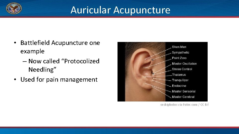 Auricular Acupuncture • Battlefield Acupuncture one example – Now called “Protocolized Needling” • Used