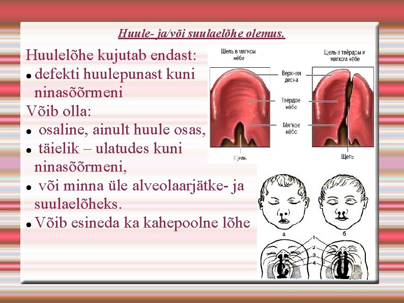 Huule- ja/või suulaelõhe olemus. Huulelõhe kujutab endast: defekti huulepunast kuni ninasõõrmeni Võib olla: osaline,