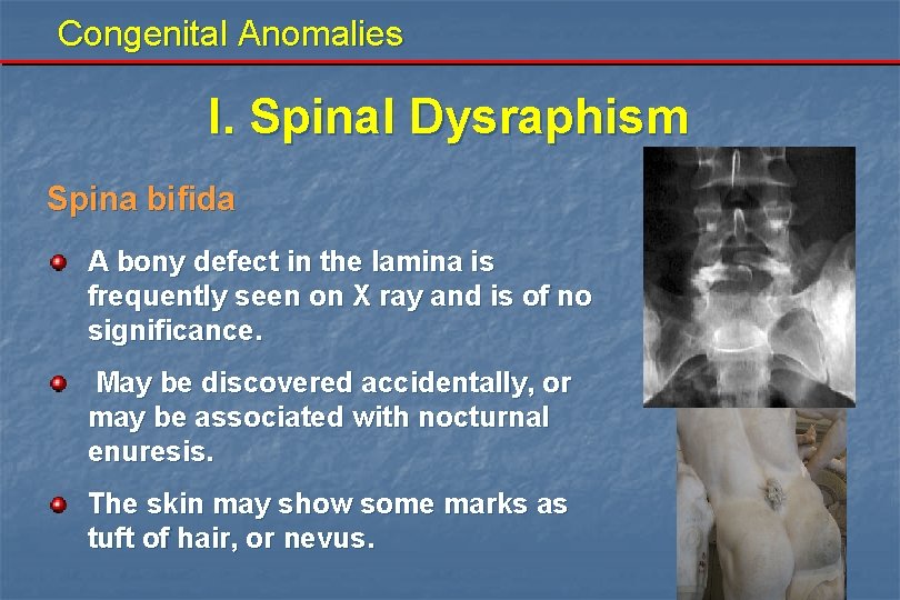 Congenital Anomalies I. Spinal Dysraphism Spina bifida A bony defect in the lamina is Congenital Anomalies I. Spinal Dysraphism Spina bifida A bony defect in the lamina is