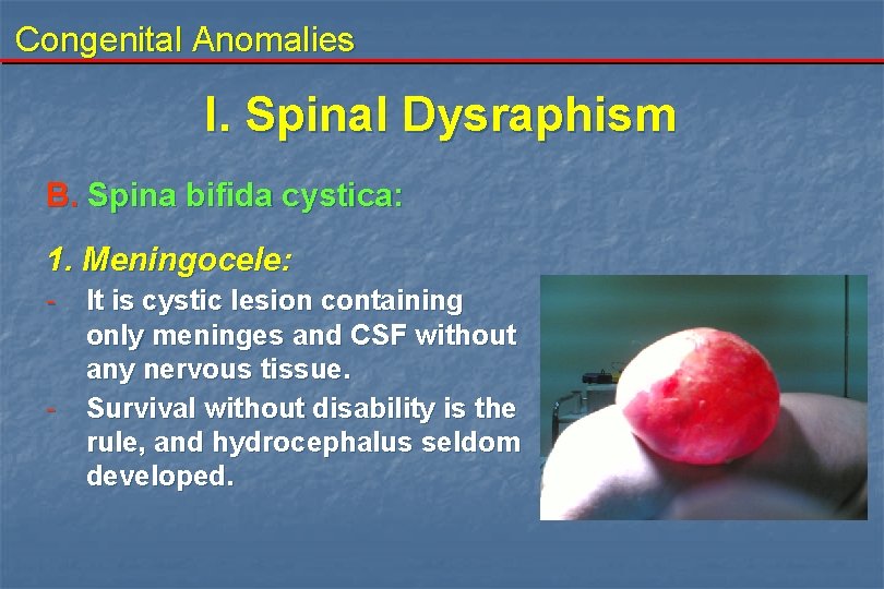 Congenital Anomalies I. Spinal Dysraphism B. Spina bifida cystica: 1. Meningocele: - - It