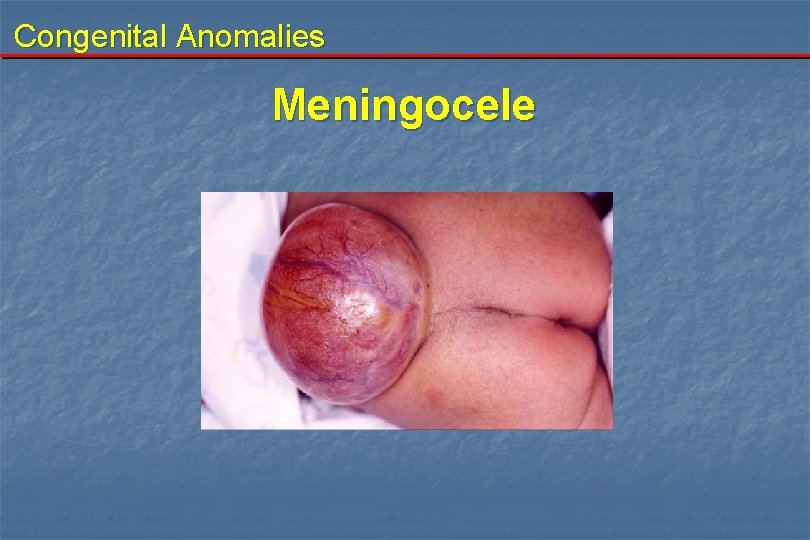 Congenital Anomalies Meningocele 